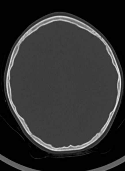 Cerebellar abscess (Radiopaedia 73727-84527 Axial bone window 46).jpg