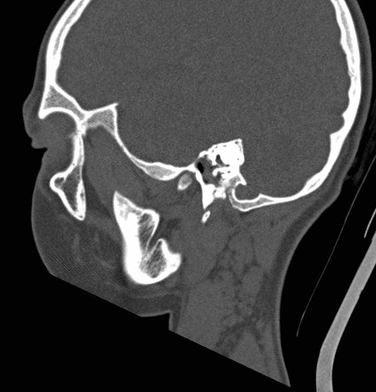 Cerebellar abscess (Radiopaedia 73727-84527 Sagittal bone window 18).jpg