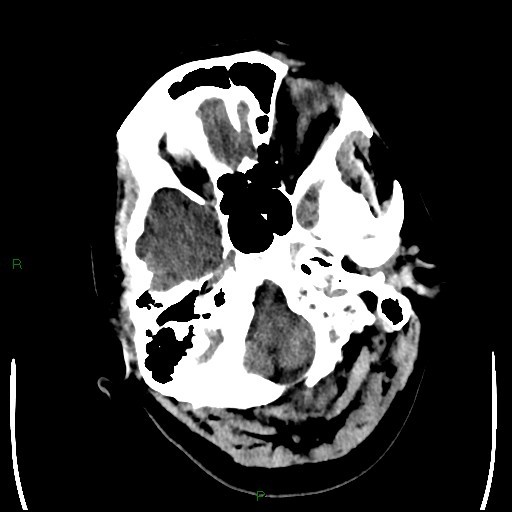 Cerebellar abscess (Radiopaedia 78135-90671 Axial non-contrast 19).jpg
