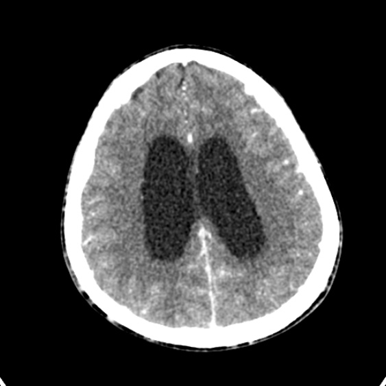 Cerebellar abscess secondary to mastoiditis (Radiopaedia 26284-26412 Axial C+ delayed 112).jpg