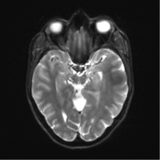 Cerebellar agenesis with hypoplastic pons (pontocerebellar hypoplasia) (Radiopaedia 57224-64138 Axial DWI 16).png