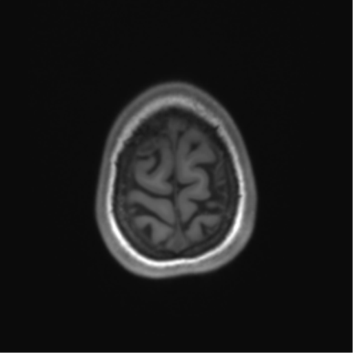 Cerebellar agenesis with hypoplastic pons (pontocerebellar hypoplasia) (Radiopaedia 57224-64138 Axial T1 70).png