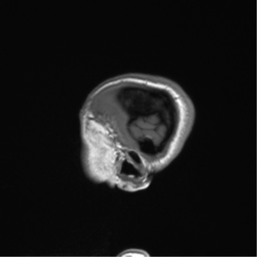 Cerebellar agenesis with hypoplastic pons (pontocerebellar hypoplasia) (Radiopaedia 57224-64138 Sagittal T1 59).png