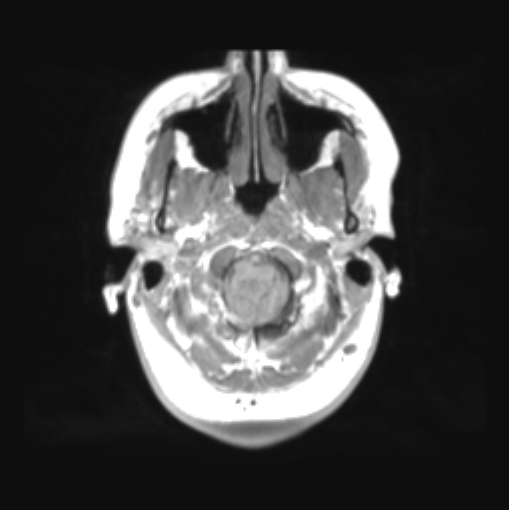 File:Cerebellar ependymoma complicated by post-operative subdural hematoma (Radiopaedia 83322-97736 Axial T1 7).png