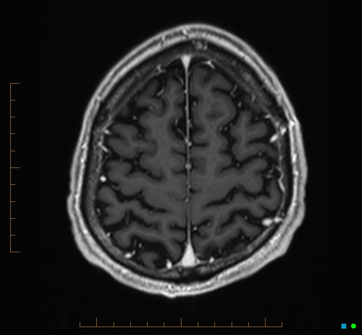 Cerebellar gangliocytoma (Radiopaedia 65377-74422 Axial T1 C+ 119).jpg