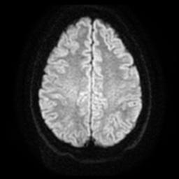 Cerebellar hemangioblastoma (Radiopaedia 29570-30077 Axial DWI 19).jpg
