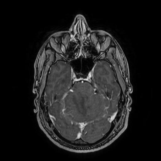File:Cerebellar hemangioblastoma (Radiopaedia 88055-104622 Axial T1 C+ 66).jpg