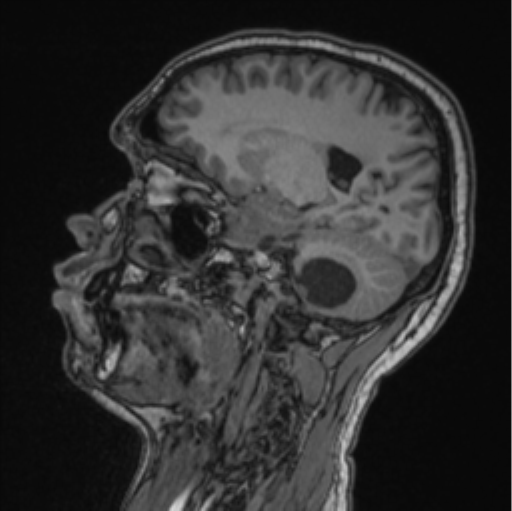 Cerebellar hemangioblastomas and pituitary adenoma (Radiopaedia 85490-101176 Sagittal T1 62).png