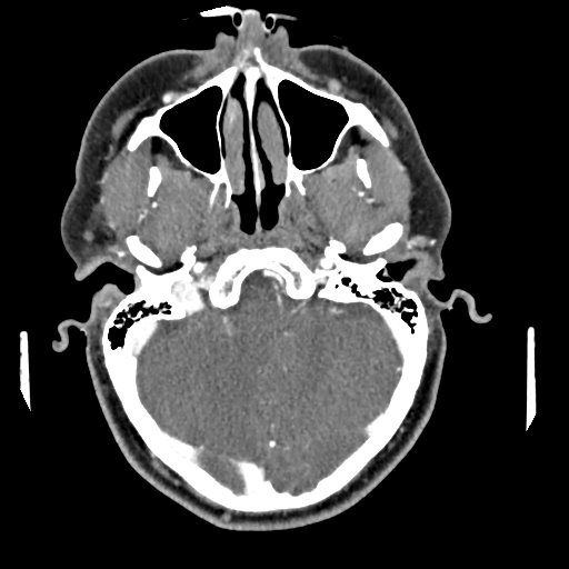 Cerebellar infarct due to vertebral artery dissection with posterior fossa decompression (Radiopaedia 82779-97029 C 26).png