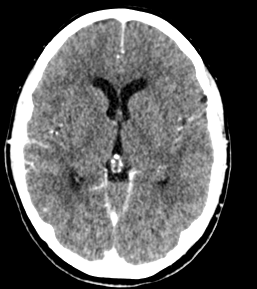 Cerebellar metastases - colorectal adenocarcinoma (Radiopaedia 40947-43652 Axial C+ 28).png