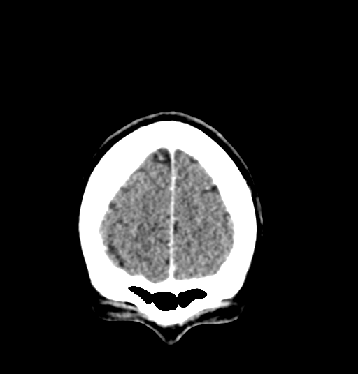 Cerebellar metastases - colorectal adenocarcinoma (Radiopaedia 40947-43652 Coronal C+ 14).png