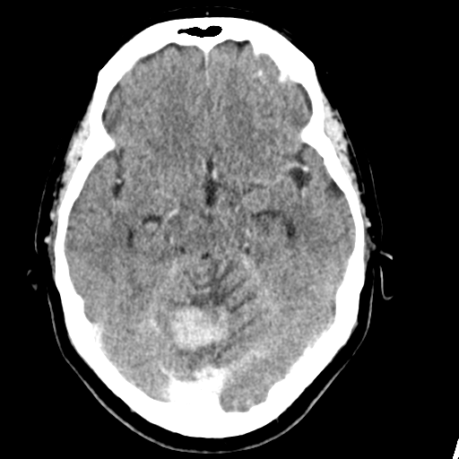 File:Cerebellar metastasis (Radiopaedia 54578-60812 Axial C+ 19).png
