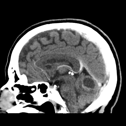 File:Cerebellar metastasis (cystic appearance) (Radiopaedia 41395-44258 F 27).png