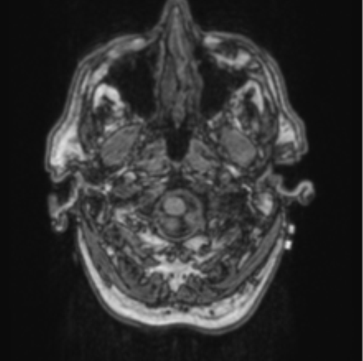 File:Cerebellar metastasis from lung adenocarcinoma (Radiopaedia 86690-102829 Axial T1 11).png