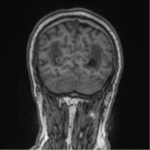 Cerebellar metastasis from lung adenocarcinoma (Radiopaedia 86690-102829 Coronal T1 21).png