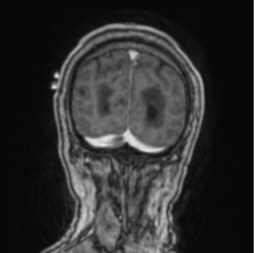 Cerebellar metastasis from lung adenocarcinoma (Radiopaedia 86690-102829 Coronal T1 C+ 14).png