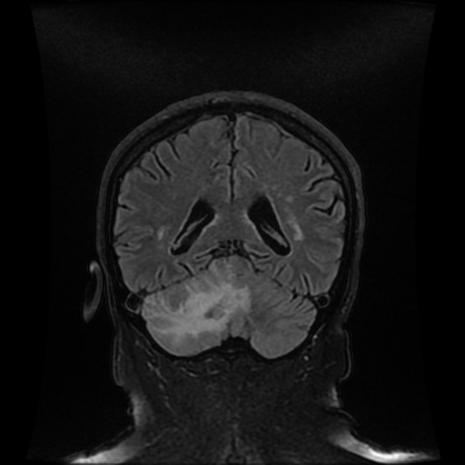 File:Cerebellar metastasis of pulmonary adenocarcinoma, cavernous venous malformation, and developmental venous anomaly (Radiopaedia 85827-101661 Coronal FLAIR 24).jpg