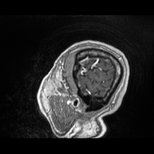 Cerebellar metastasis of pulmonary adenocarcinoma, cavernous venous malformation, and developmental venous anomaly (Radiopaedia 85827-101661 Sagittal T1 C+ 16).jpg