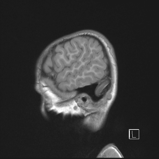 Cerebellar stroke (Radiopaedia 32202-33150 Sagittal T1 C+ 5).png