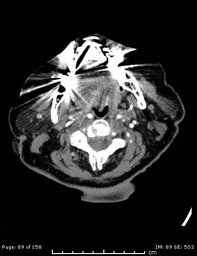 Cerebellar strokes due to intracranial giant cell arteritis (Radiopaedia 68799-78510 CT angiogram 89).jpg