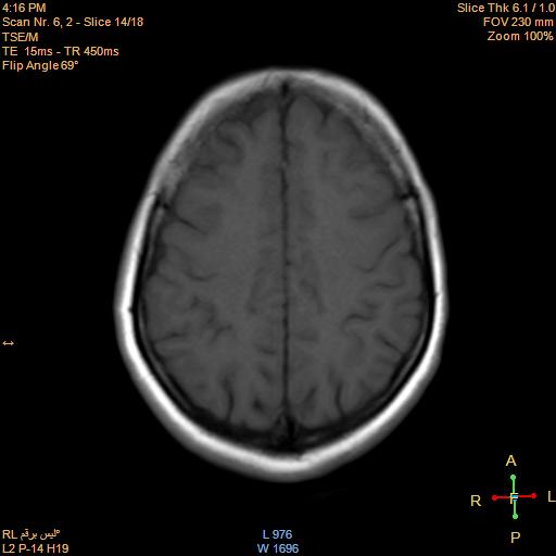 File:Cerebellopontine angle meningioma (Radiopaedia 22488-22525 Axial T1 13).jpg
