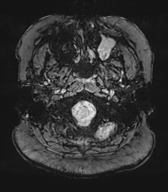 Cerebellopontine angle meningioma (Radiopaedia 48434-53348 Axial SWI 7).png