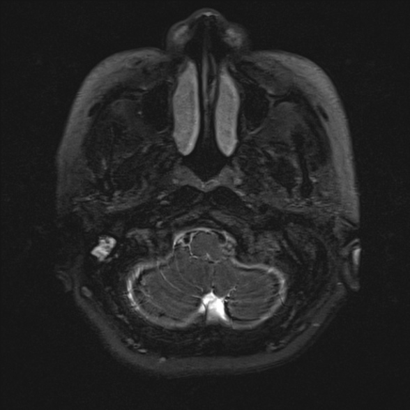 Cerebellopontine angle meningioma (Radiopaedia 53561-59591 Axial 3D volume T2 16).jpg