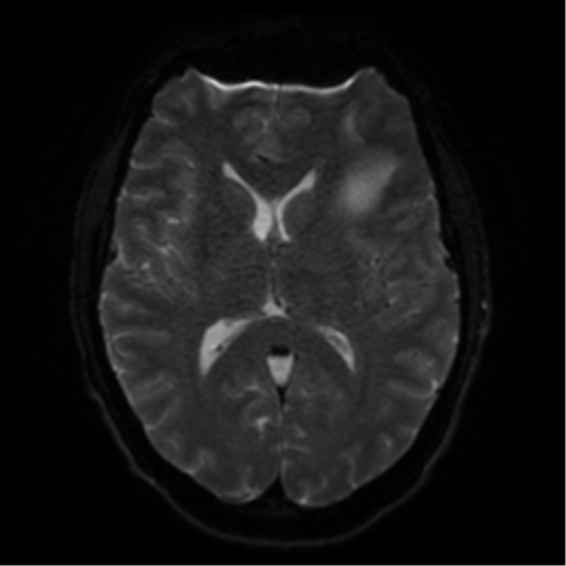 Cerebral abscess (Radiopaedia 57774-64740 Axial DWI 44).png
