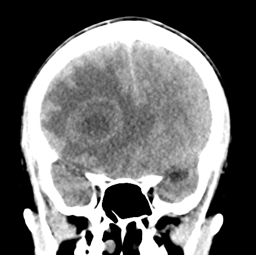 Cerebral abscess (Radiopaedia 60342-68008 Coronal non-contrast 22).png