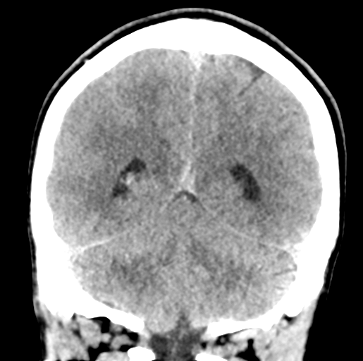 Cerebral abscess (Radiopaedia 60342-68008 Coronal non-contrast 46).png