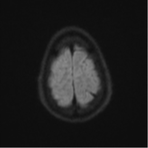Cerebral abscess (Radiopaedia 60342-68009 Axial DWI 68).png