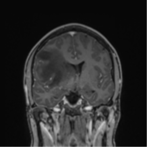 File:Cerebral abscess (Radiopaedia 60342-68009 H 28).png