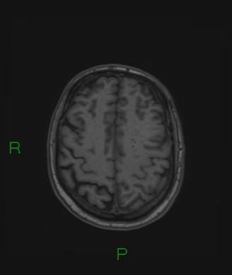 Cerebral abscess and subdural empyema (Radiopaedia 84436-99779 Axial T1 25).jpg