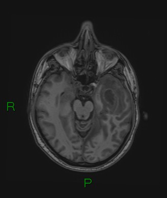 Cerebral abscess and subdural empyema (Radiopaedia 84436-99779 Axial T1 54).jpg
