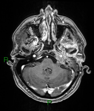 Cerebral abscess and subdural empyema (Radiopaedia 84436-99779 Axial T1 C+ 67).jpg