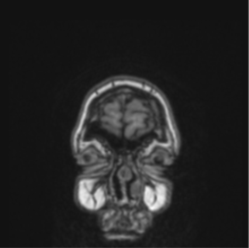 Cerebral abscess from pulmonary arteriovenous malformation (Radiopaedia 86275-102291 Coronal T1 84).png
