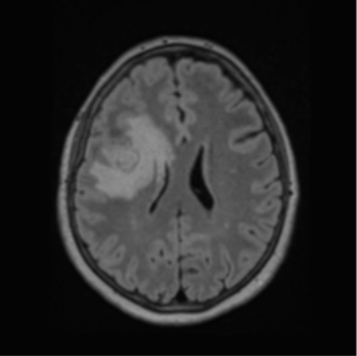 File:Cerebral abscess from pulmonary arteriovenous malformation (Radiopaedia 86275-102291 J 48).png