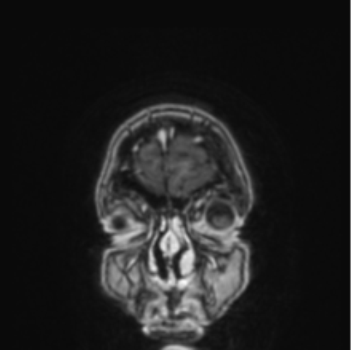 Cerebral abscess from pulmonary arteriovenous malformation (Radiopaedia 86275-102291 L 83).png