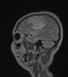 Cerebral abscess from pulmonary arteriovenous malformation (Radiopaedia 86275-102291 Sagittal FLAIR 56).png