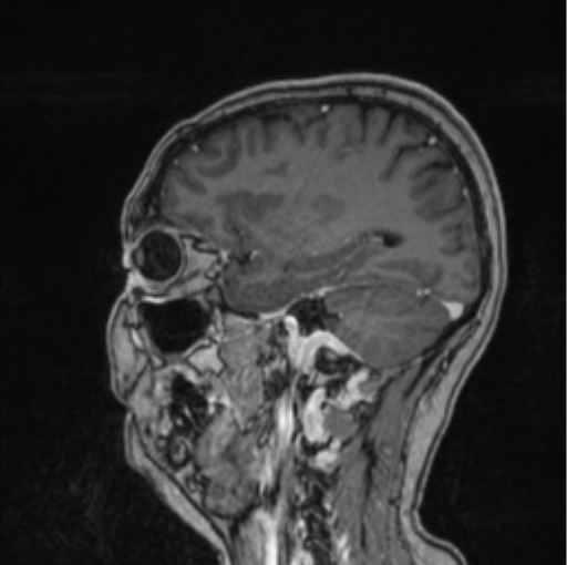 Cerebral abscess from pulmonary arteriovenous malformation (Radiopaedia 86275-102291 Sagittal T1 C+ 25).png