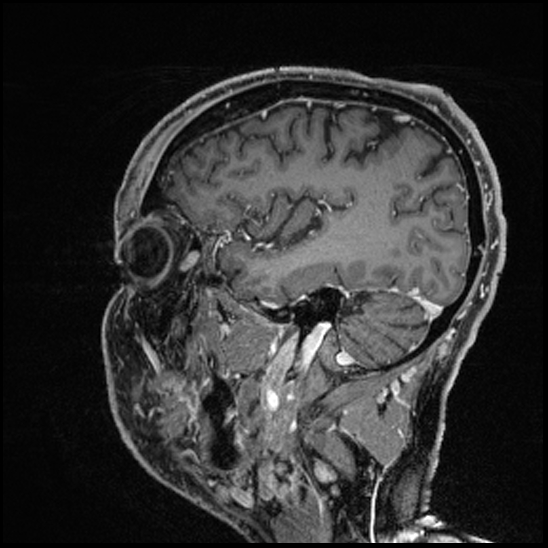 Cerebral abscess with ventriculitis (Radiopaedia 78965-91878 Sagittal T1 C+ 49).jpg