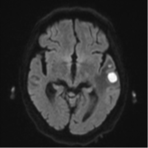 Cerebral abscesses- medically managed (Radiopaedia 45183-49179 Axial DWI 41).png