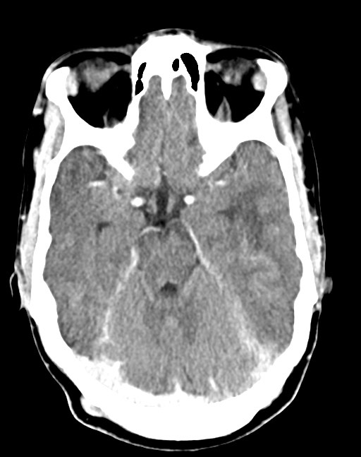 Cerebral abscesses (Radiopaedia 70458-80568 Axial Contrast 24).jpg