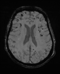 Cerebral amyloid angiopathy-related inflammation (Radiopaedia 74836-85849 Axial SWI 44).jpg