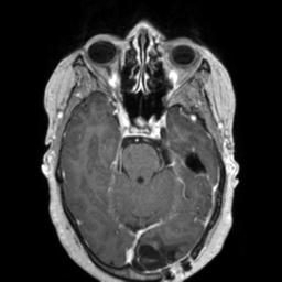 File:Cerebral amyloid angiopathy (Radiopaedia 29129-29518 Axial T1 C+ 52).jpg