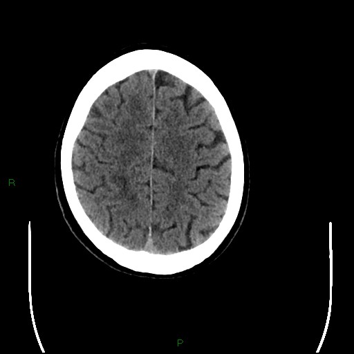 File:Cerebral amyloid angiopathy (Radiopaedia 77506-89665 Axial non-contrast 85).jpg