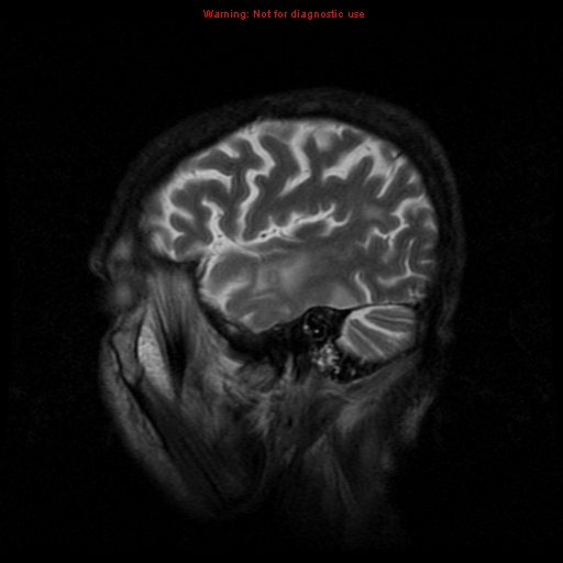 File:Cerebral and orbital tuberculomas (Radiopaedia 13308-13311 Sagittal T2 3).jpg