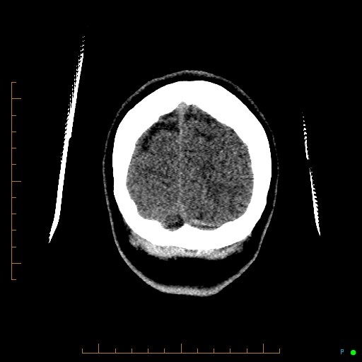 File:Cerebral arteriovenous malformation (AVM) (Radiopaedia 78162-90706 Coronal non-contrast 90).jpg
