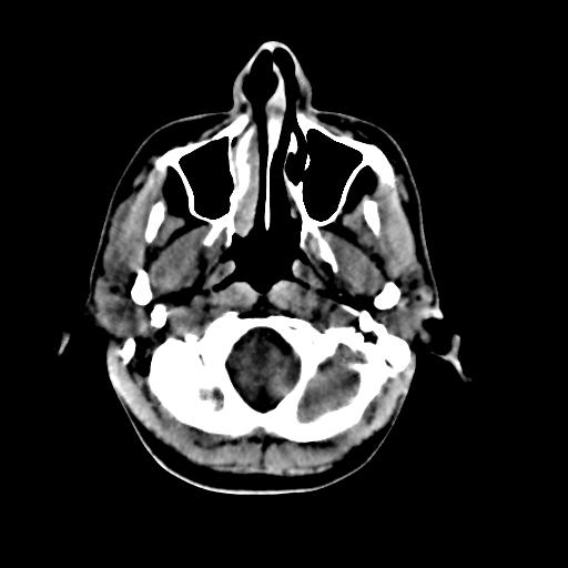 Cerebral arteriovenous malformation (Radiopaedia 28518-28759 Axial non-contrast 6).jpg