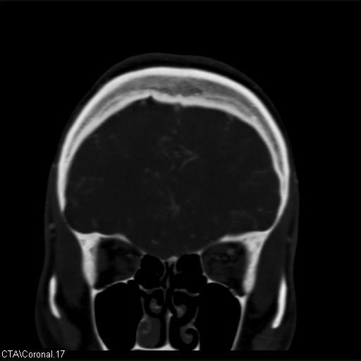 File:Cerebral arteriovenous malformation (Radiopaedia 28518-28759 C 17).jpg